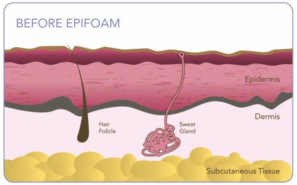 Epifoam lipofoam insert pads biodermins - RECOVA®
